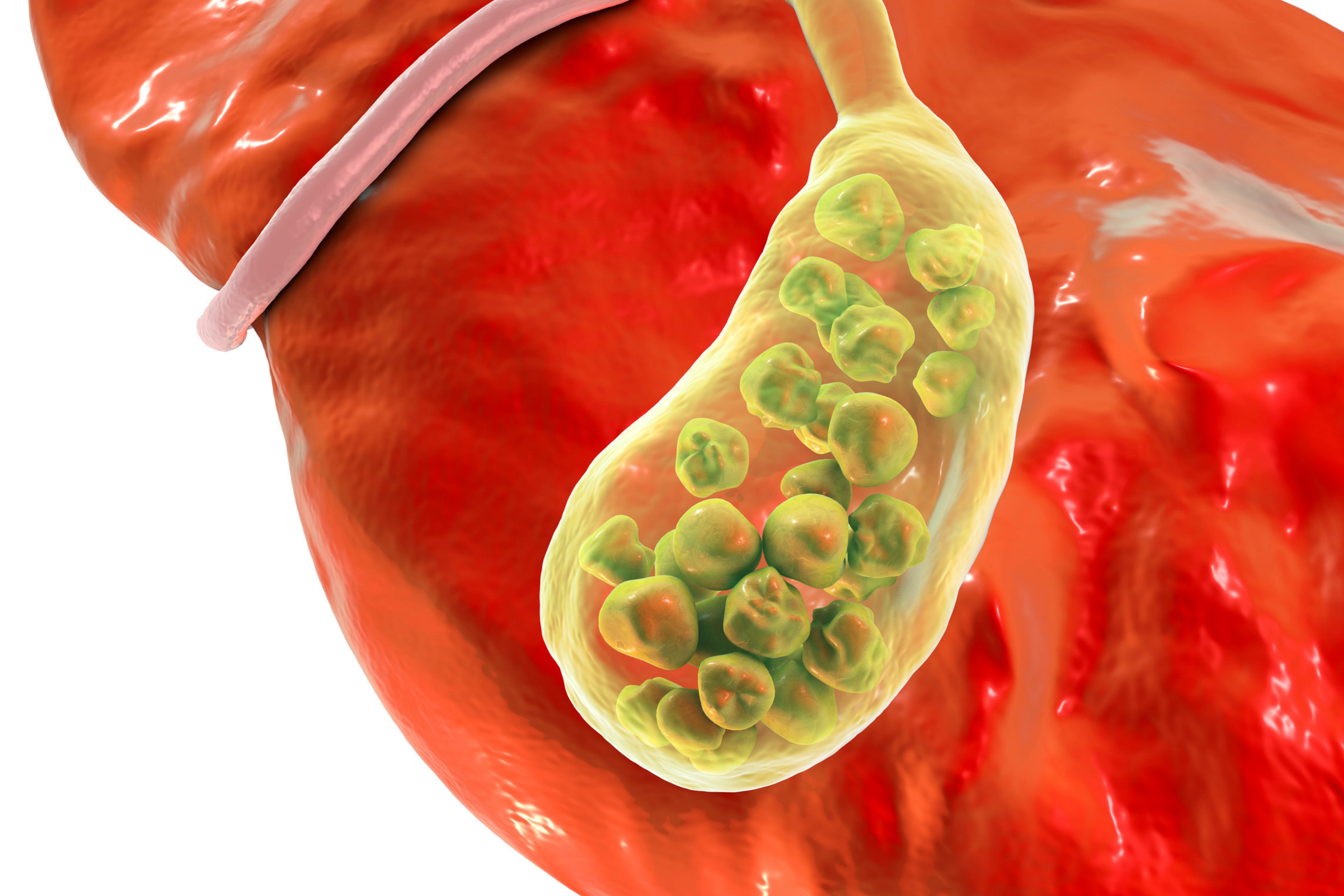 Not Every Gallbladder Stone Requires Surgery