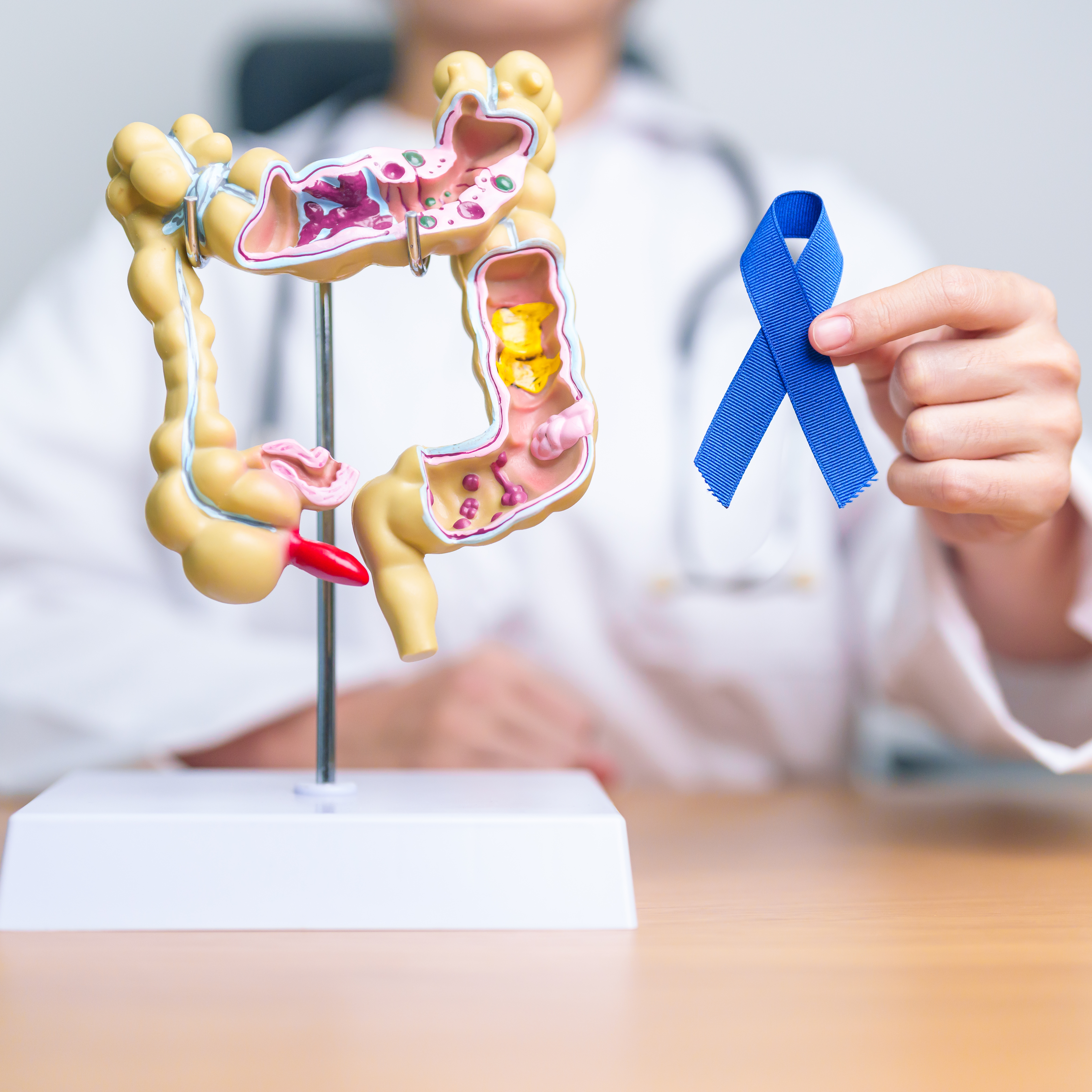 The Importance of Early Diagnosis in Colon Cancer