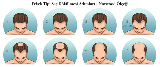 Male Pattern Hair Loss Stages - Norwood Scale